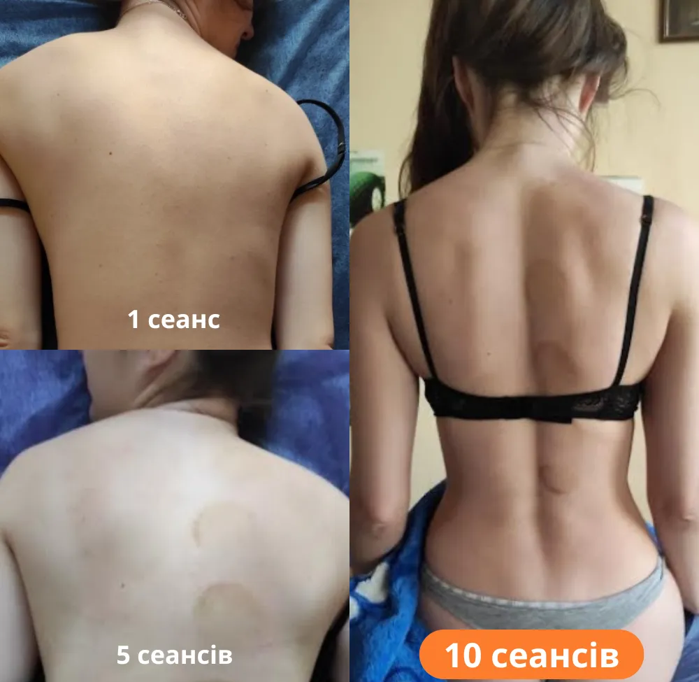 Исправление перекоса плеч – лечебный массаж Днепр